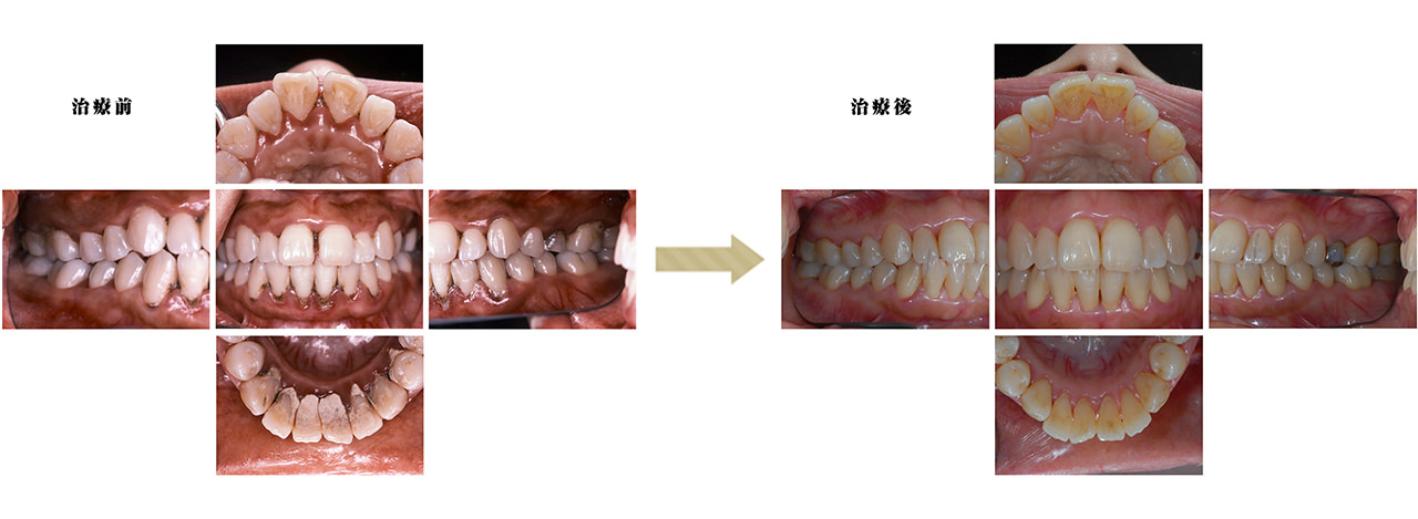 ”全顎歯周治療例”